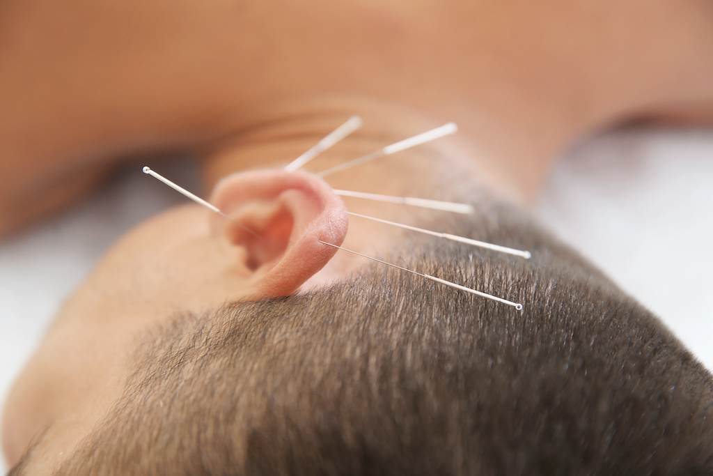 acupuncture_and_sports_performance